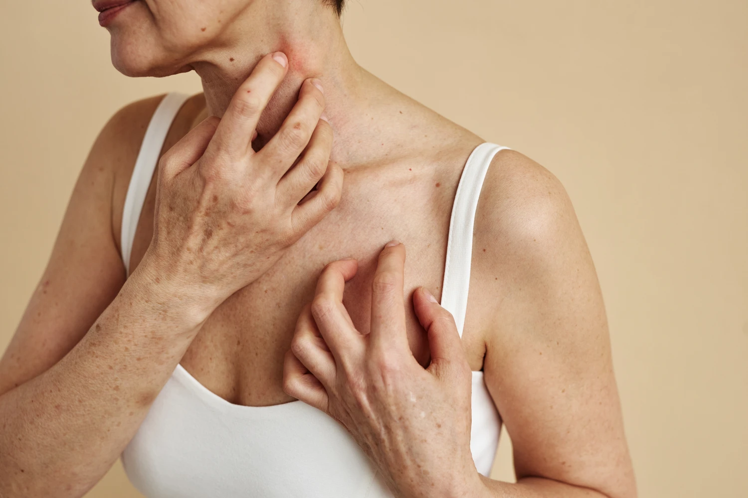 close-up-of-woman-scratching-neck-itch-and-allergi-2023-10-31-05-33-36-utc